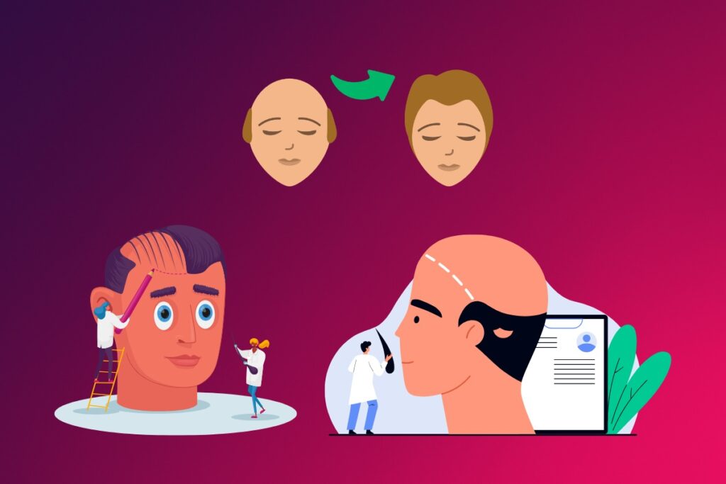 Hair Transplant Statistics